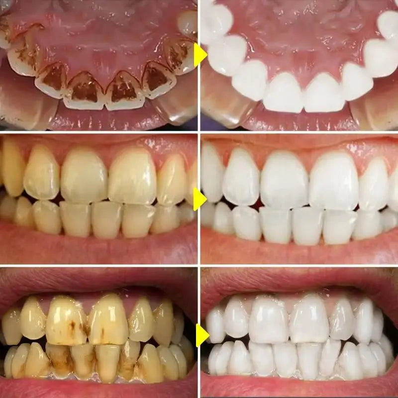 Polvo blanqueador dental de 5 días que elimina manchas de placa, sarro y problemas de higiene bucal. Productos para el cuidado dental.