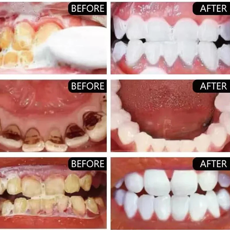 Polvo blanqueador dental de 5 días que elimina manchas de placa, sarro y problemas de higiene bucal. Productos para el cuidado dental.