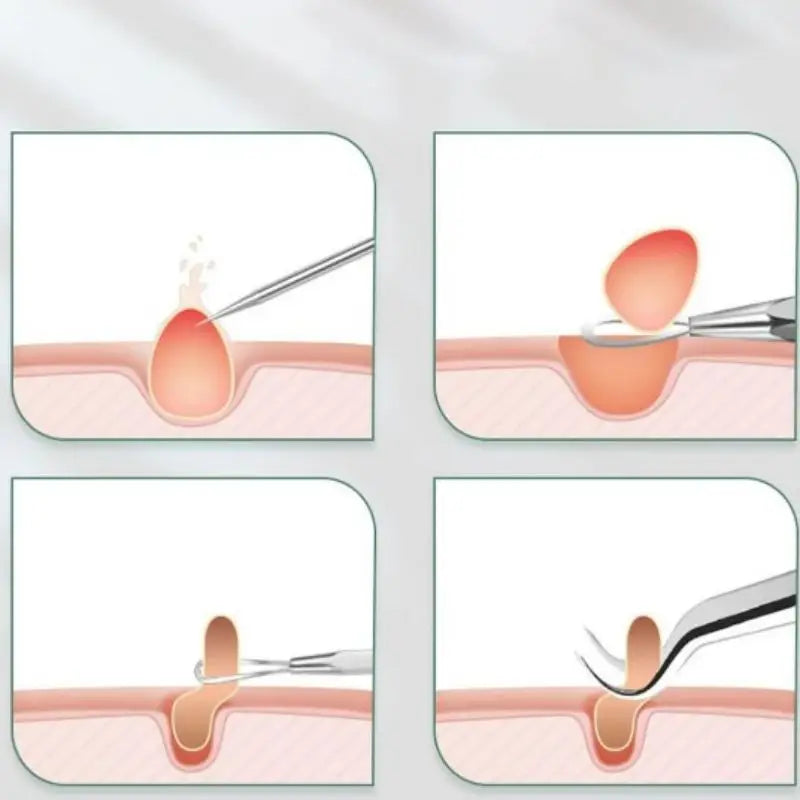 5 agujas para el acné de acero inoxidable para eliminar puntos negros, pinzas de doble punta para el acné.